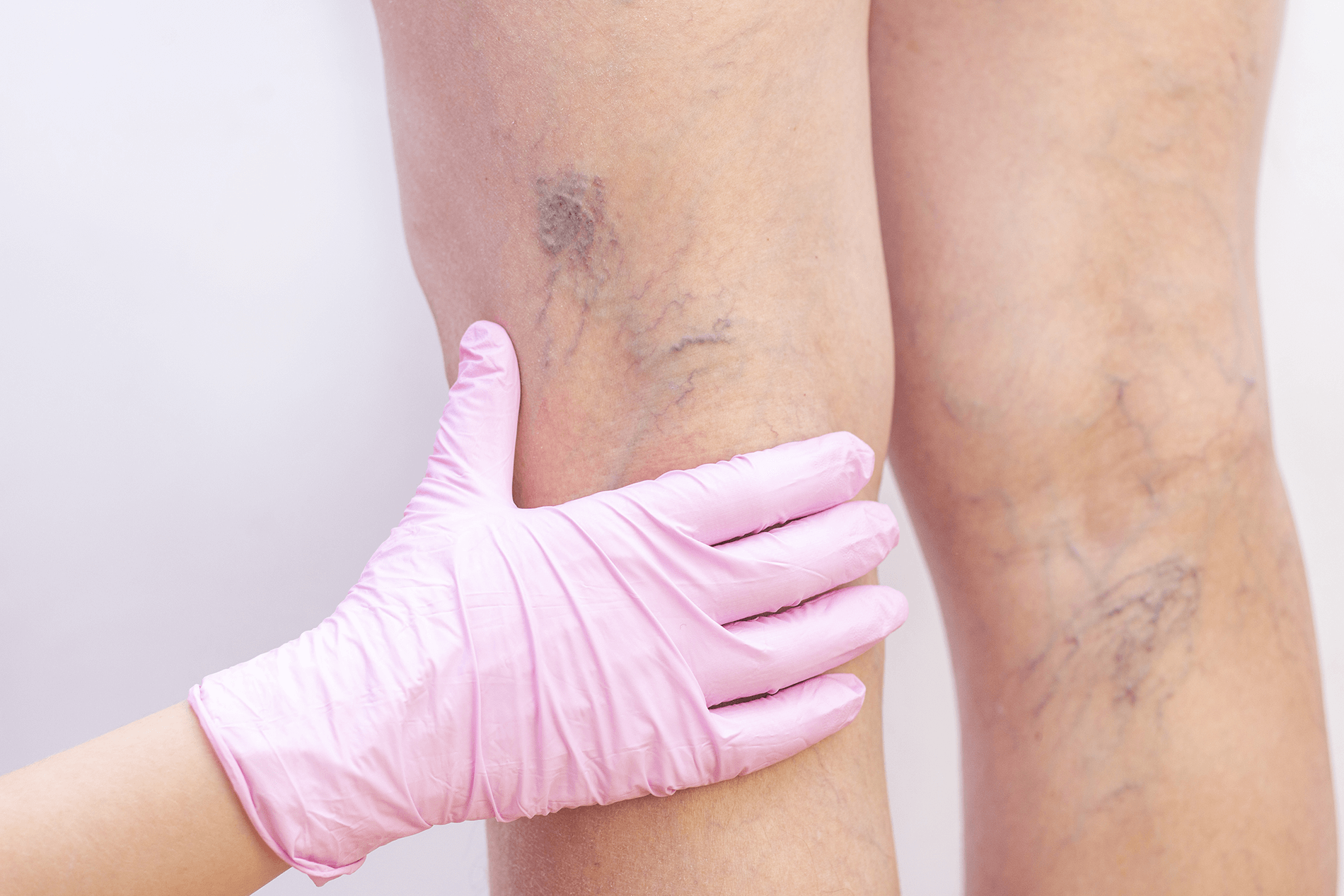 Les pathologies veineuses : un phénomène sous estimé